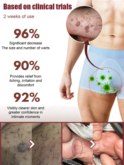 Intimate Area Wart Removal Cream – Visible Results in One Week