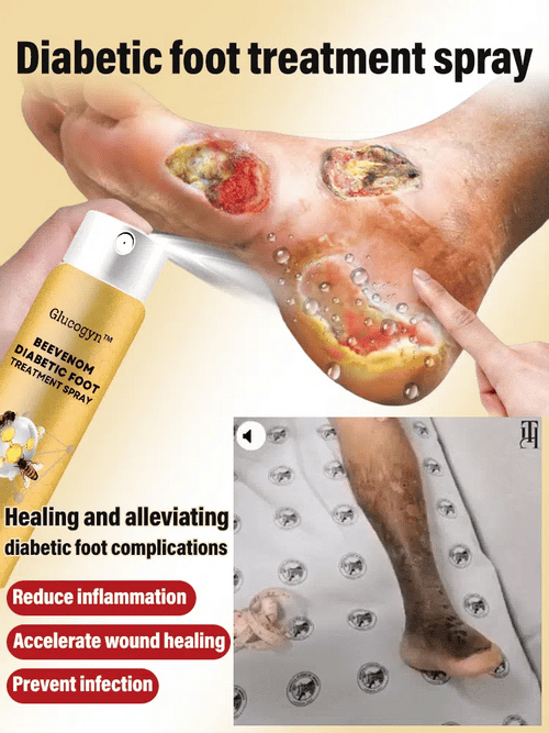 Diabetic foot treatment spray
