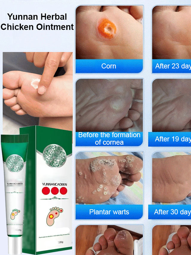 7 Days Pain-Free Herbal Cocoon Removal Cream