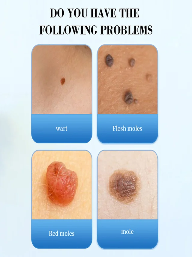 Mole and wart removal care solution