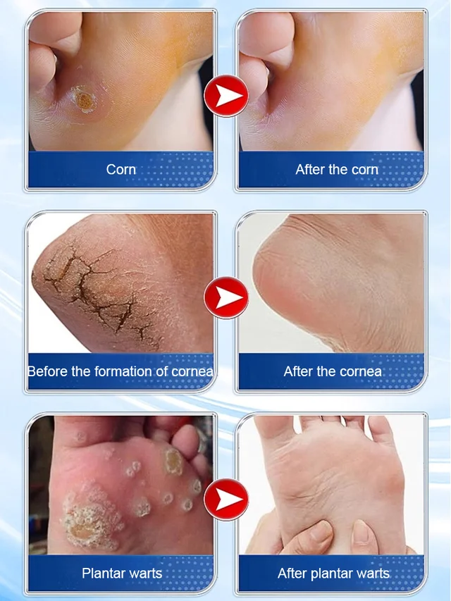 7 Days Pain-Free Herbal Cocoon Removal Cream