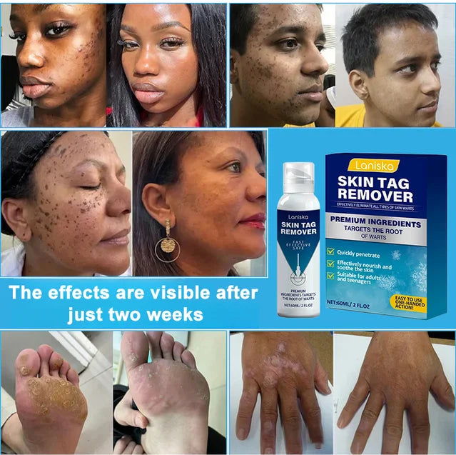 Cryotherapy Spray🌬️Instant cooling relief—say goodbye to discomfort, hello to comfort!