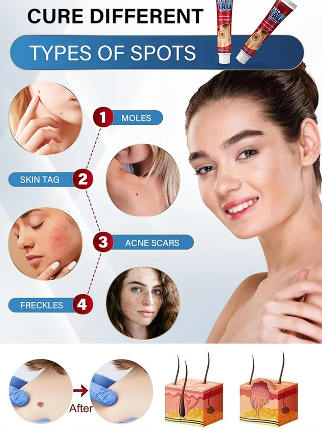 Herbal wart and corn removal cream