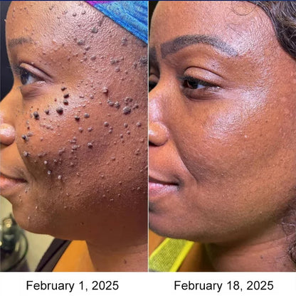 Cryotherapy Spray🌬️Instant cooling relief—say goodbye to discomfort, hello to comfort!