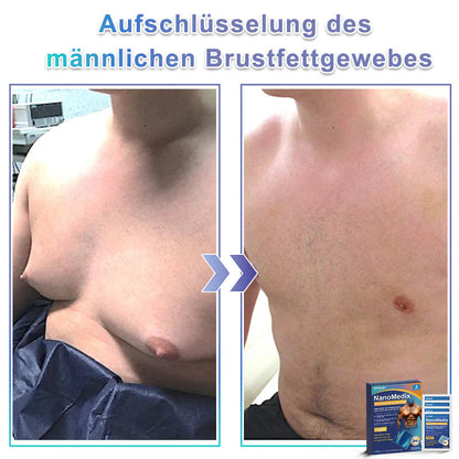 🔥STARTYNX®NanoMedix™ Gynecomastia Breast Fat Burning & Firming Patch