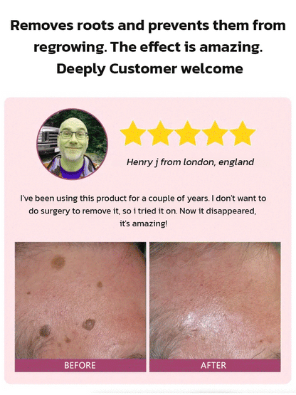 Herbal wart and corn removal cream