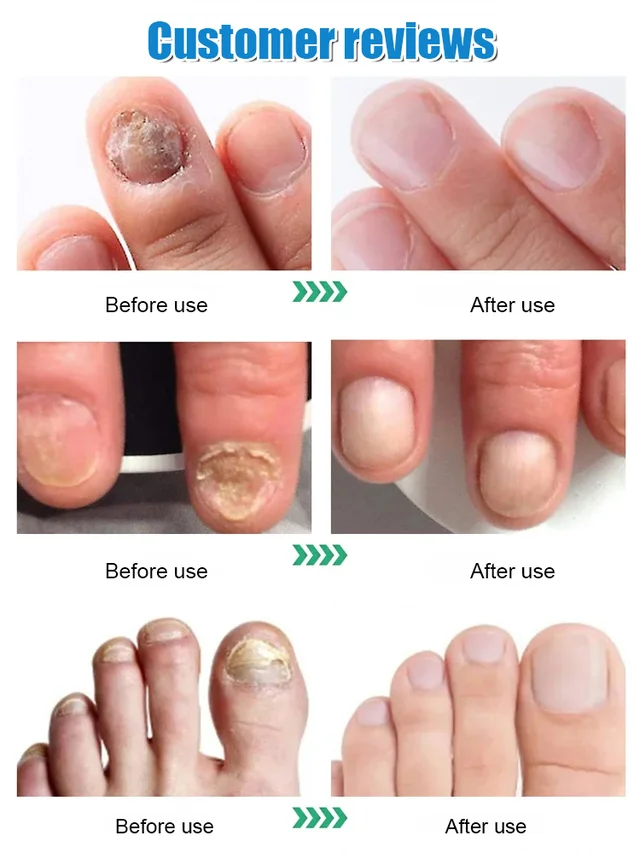 Ginger Nail Care Solution
