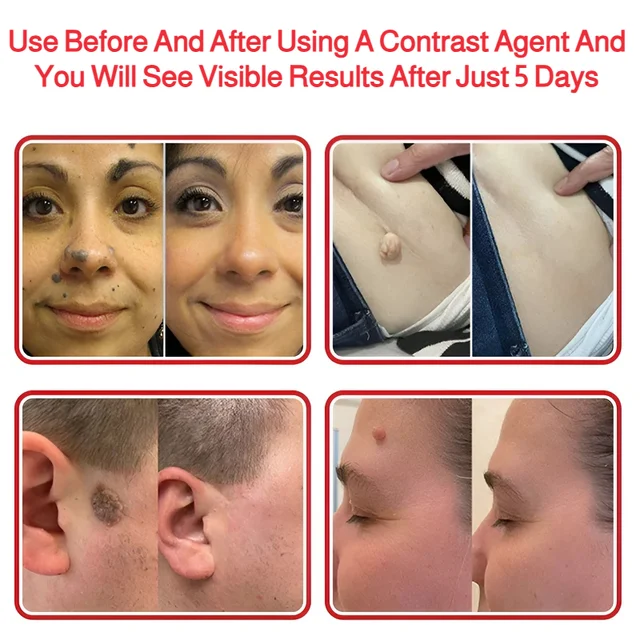 Patch Wart Flesh Mole Acne Patch Beauty Skin Care No Pain Easy To Operate