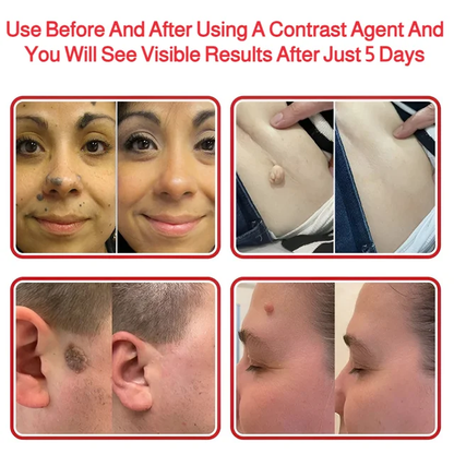 Patch Wart Flesh Mole Acne Patch Beauty Skin Care No Pain Easy To Operate