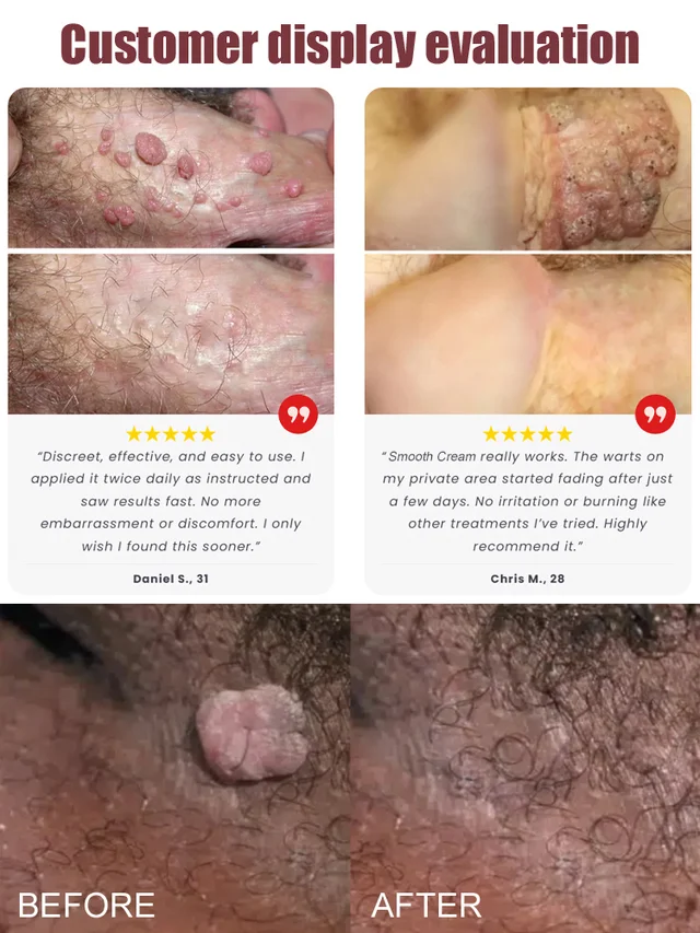 Intimate Area Wart Removal Cream – Visible Results in One Week