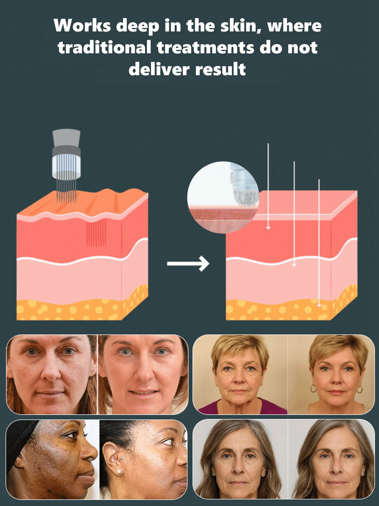 ANTI-WRINKLE MICRONEEDLE SERUM SET