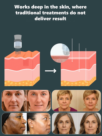 ANTI-WRINKLE MICRONEEDLE SERUM SET