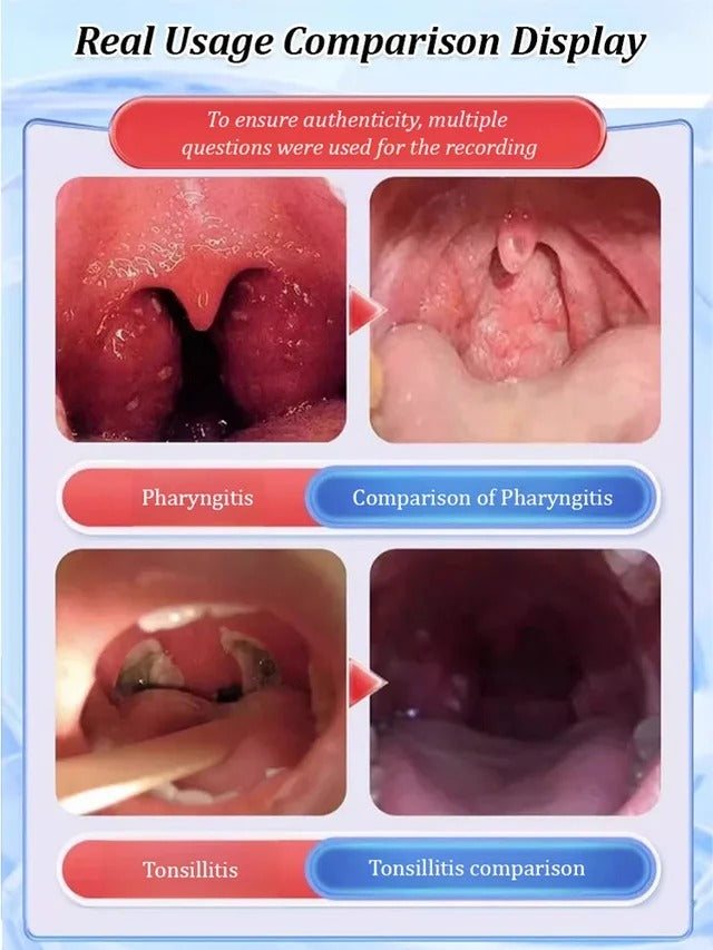 Acute and chronic pharyngeal flatulence gel